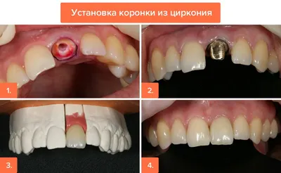 Циркониевые коронки, цена в Москве на диоксид циркония, коронки цена на циркониевые  коронки на передние зубы, стоимость коронки из циркония, цена в Москве