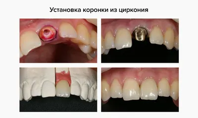 Безметалловые коронки — Акции