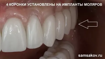 Циркониевые коронки в СПб – цены и установка коронок из диоксида циркония