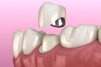 🦷 Керамические коронки E-max ☑ Стоматология в Киеве и Львове ☑ Giorno  Dentale