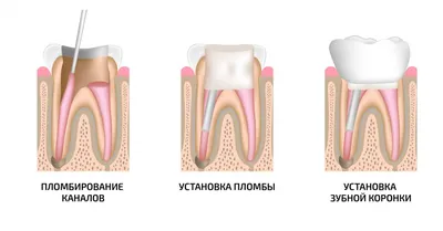 Зубные коронки - полезные статьи стоматологической сферы в блоге «Гелиоса».