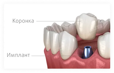 Какие зубные коронки лучше ставить в разных случаях | Альянс  бьюти-ортопедов, Москва