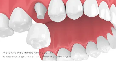Коронка на зуб: цены под ключ на установку зубных коронок, этапы  протезирования — ROOTT