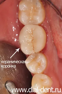 Коронки на зубы - виды и преимущества