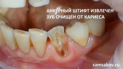 Какие зубы никакая коронка не испортит, а когда она бесполезна | Альянс  бьюти-ортопедов, Москва