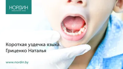 ВЛИЯНИЕ КОРОТКОЙ УЗДЕЧКИ ЯЗЫКА НА ЗВУКОПРОИЗНОШЕНИЕ У ДЕТЕЙ – тема научной  статьи по клинической медицине читайте бесплатно текст  научно-исследовательской работы в электронной библиотеке КиберЛенинка