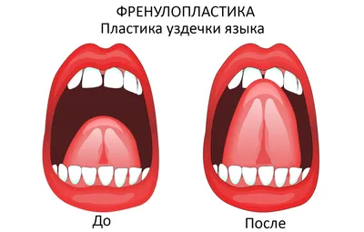 Пластика уздечки языка - Сеть стоматологических клиник Санкт-Петербурга -  Мир стоматологии