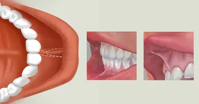 Пластика уздечки зуба. Подрезание короткой уздечки в стоматологии Лекта  Мытищи