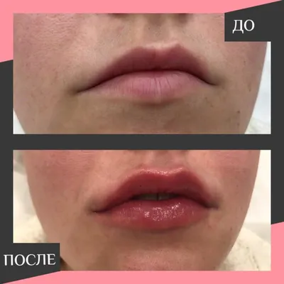 Увеличение и коррекция формы губ гиалуроновой кислотой в Jolly Clinic