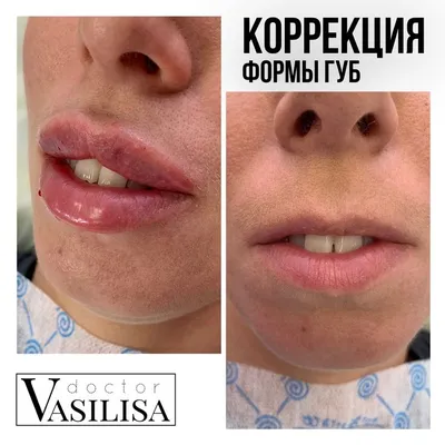 Увеличение губ и коррекция формы – фотографии до и после