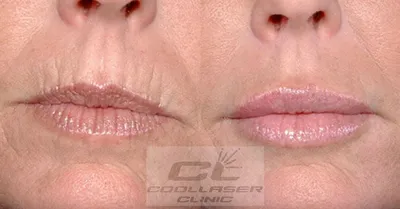 Увеличение и коррекция губ губки бантиком | Doctor, Photo and video,  Instagram photo