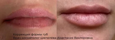 Контурная пластика губ в Москве: цена процедуры, фото до и после, отзывы |  Стоимость коррекции контура губ филлерами в клинике Seline
