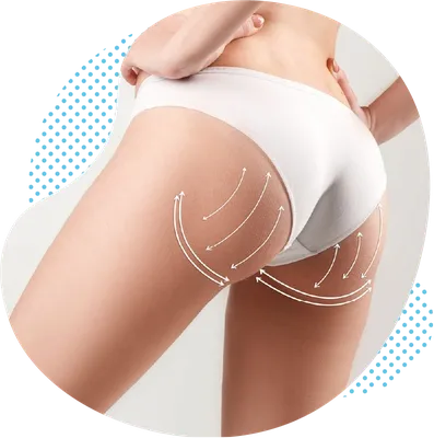 Brazilian Butt Lift (Бразильская Подтяжка Ягодиц) - Clinica de Medicină  Estetică și Chirurgie Plastică