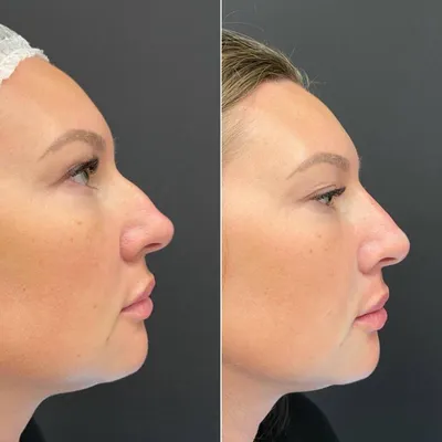 Dr.Annet - Как я делаю носы идеальными? На самом деле, существует несколько  способов коррекции для достижения красивого и ровного носа, как в профиль,  так и в анфас: 1. Коррекция филлером 2. Коррекция