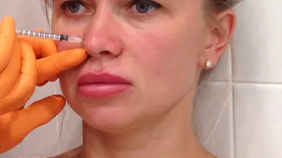 Коррекция носа филлерами в Москве | Центр эстетической медицины «МариЛав»