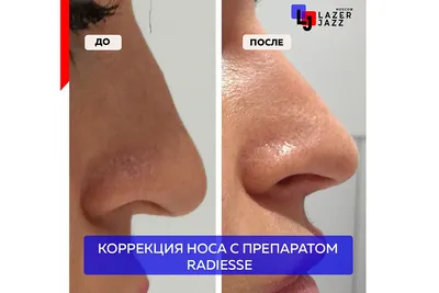 Коррекция носа филлерами в Москве | Центр эстетической медицины «МариЛав»