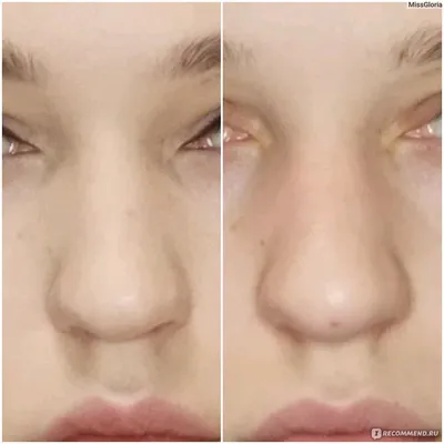 Коррекция носа без операции - body-face.com.ua