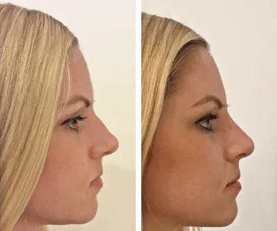 Ринопластика без операции — коррекция носа филлерами всего за 5 минут