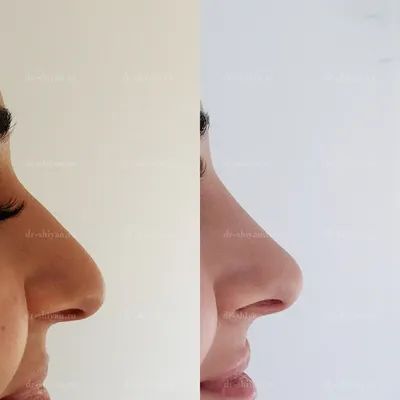 Коррекция горбинки носа в 2 этапа. Использовано: филлер + Ботокс На  Следующую коррекцию через 6-8 месяцев, затем через… | Instagram