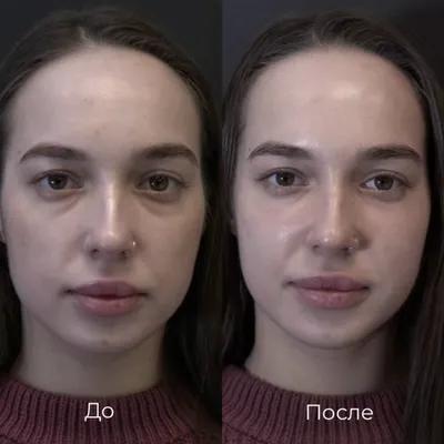 Коррекция носослезной борозды фото до и после фото