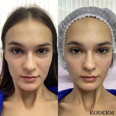 До и после: фото женщин, которые сделали коррекцию носослезки | WDAY