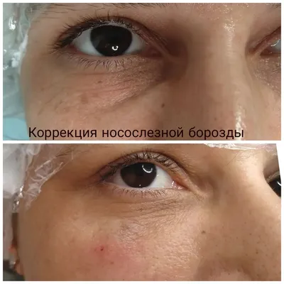 Коррекция носослезной борозды | Цены, Москва | Age Clinic Москва