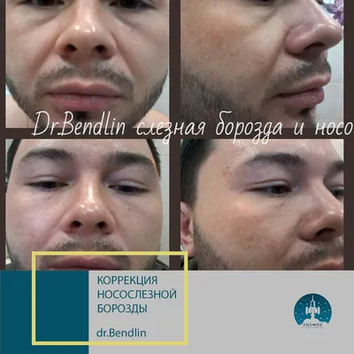 Коррекция носослезной борозды филлерами в Москве | Центр эстетической  медицины «МариЛав»