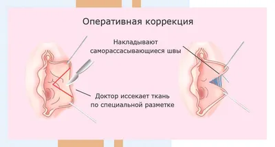 Лабиопластика - это коррекция формы и... - Клиника Медлайн. | Facebook