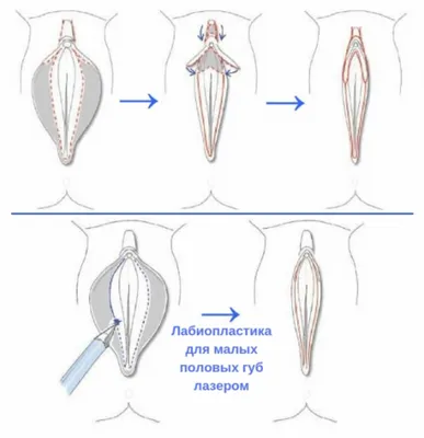 Лабиопластика в Минске | Медицинский центр Эра