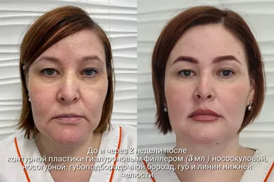 Бьютификация лица. До и После (Фото)
