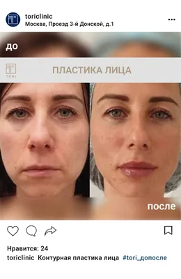Инъекционная косметология в Ижевске - контурная пластика