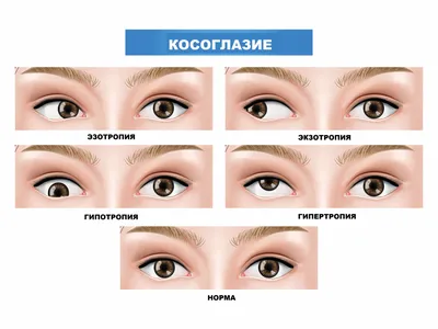 Косоглазие — Глазная клиника — Добрий зiр