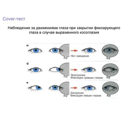 Лечение косоглазия - Clean View Clinic