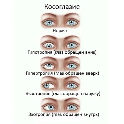 Косоглазие - причины появления, при каких заболеваниях возникает,  диагностика и способы лечения