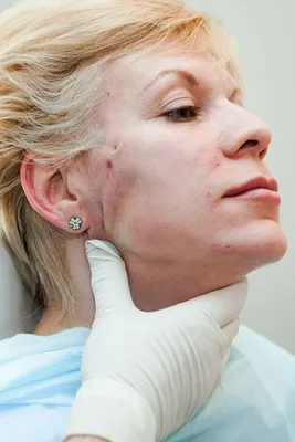 Подтяжка лица нитями: фото до и после нитевого лифтинга, отзывы о Себа |  Beauty Insider