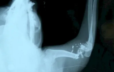 Пример из практики: диафизарный перелом плечевой кости. Послеоперационная  терапия.