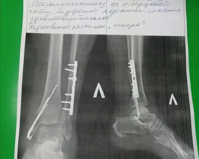 Прошло 4 месяца после перелома ноги. Сделала рентген, показываю, что с  ногой. | жизнь и Крым | Дзен