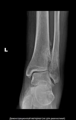 Перелом латеральной лодыжки. | Портал радиологов