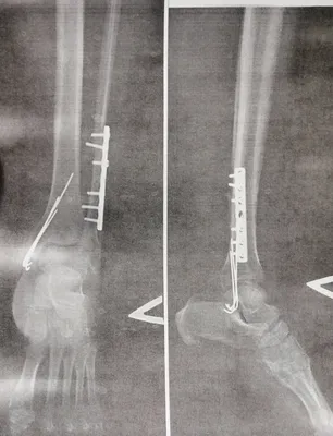 Прошло 4 месяца после перелома ноги. Сделала рентген, показываю, что с  ногой. | жизнь и Крым | Дзен