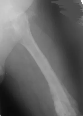 Рентгенография бедренной кости | Портал радиологов
