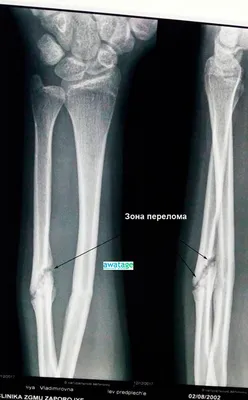 Лечение переломов, псевдоартроза с помощью ударно-волновой терапией в Киеве  | Медцентр Аватаж