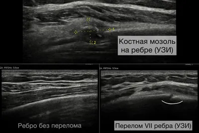 Костная мозоль после ринопластики