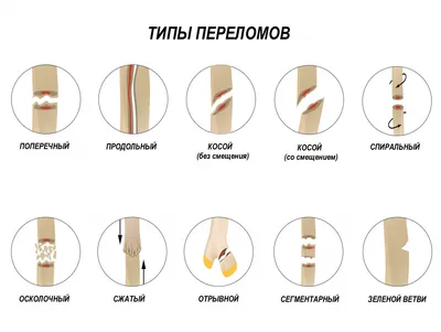 Экстоз(костная мозоль)малоберцовой кости в проекции межберцового  сочленения. | Консультация травматолога в Минске на DOKTORA.BY - ВРАЧИ  БЕЛАРУСИ