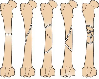 Перелом кости - причины появления, симптомы заболевания, диагностика и  способы лечения