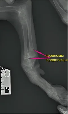 Как быстро срастется перелом у детей, пожилых и взрослых?