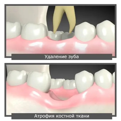 ᐉ Костная пластика • Цена в Краматорске ⇒ Наращивание костной ткани при  имплантации зубов