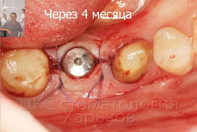 Костная пластика: Наращивание костной ткани при имплантации зубов цены в СПб