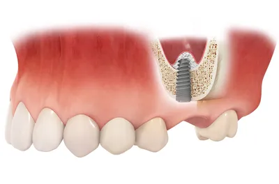 наращивание костной ткани для имплантации зубов