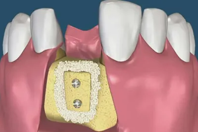 Аугментация костной ткани в стоматологической клинике Эстетика