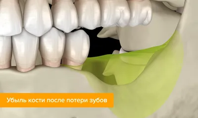 Наращивание костной ткани для имплантов (костная пластика) - цена в СПб
